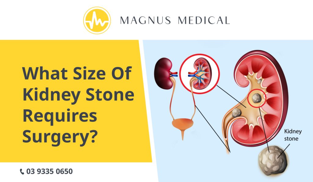 What Size of Kidney Stone Requires Surgery