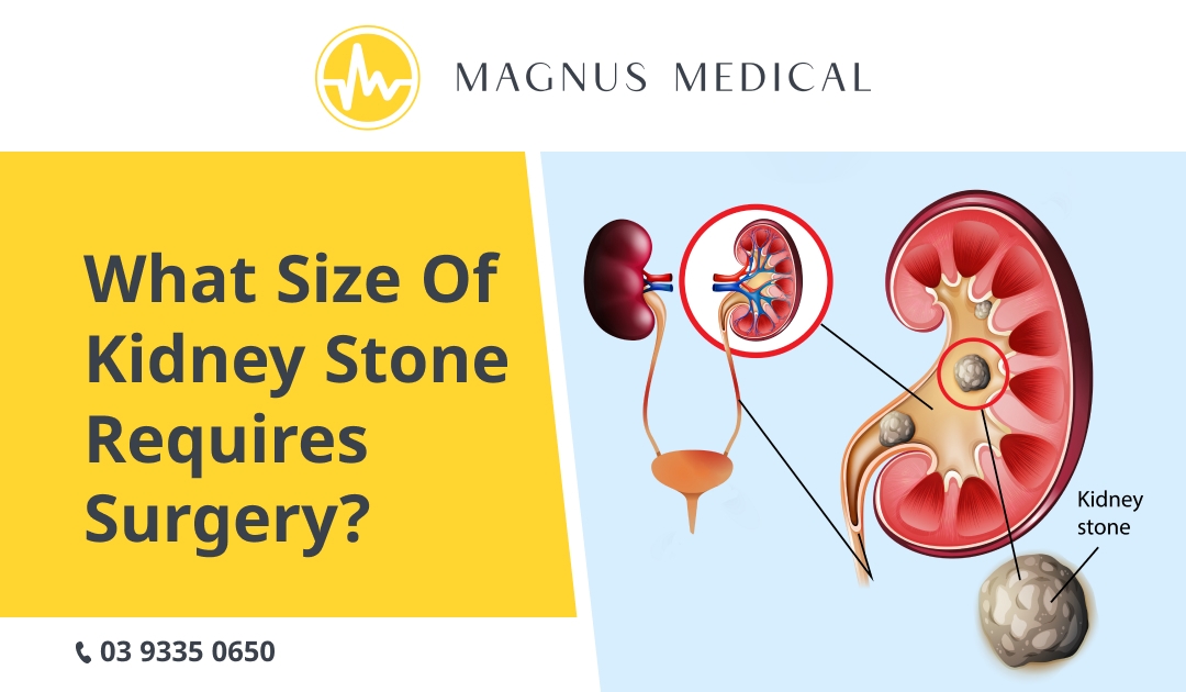 What Size of Kidney Stone Requires Surgery
