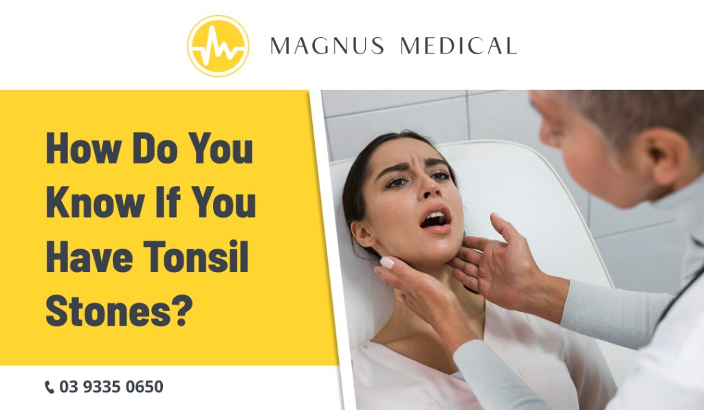 How Do You Know If You Have Tonsil Stones