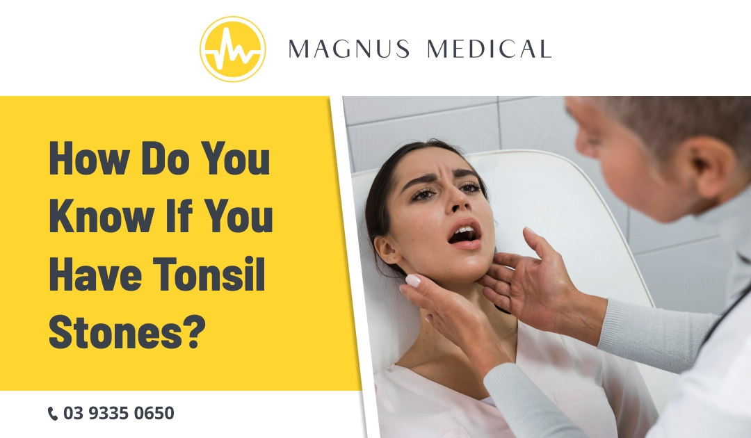 How Do You Know If You Have Tonsil Stones