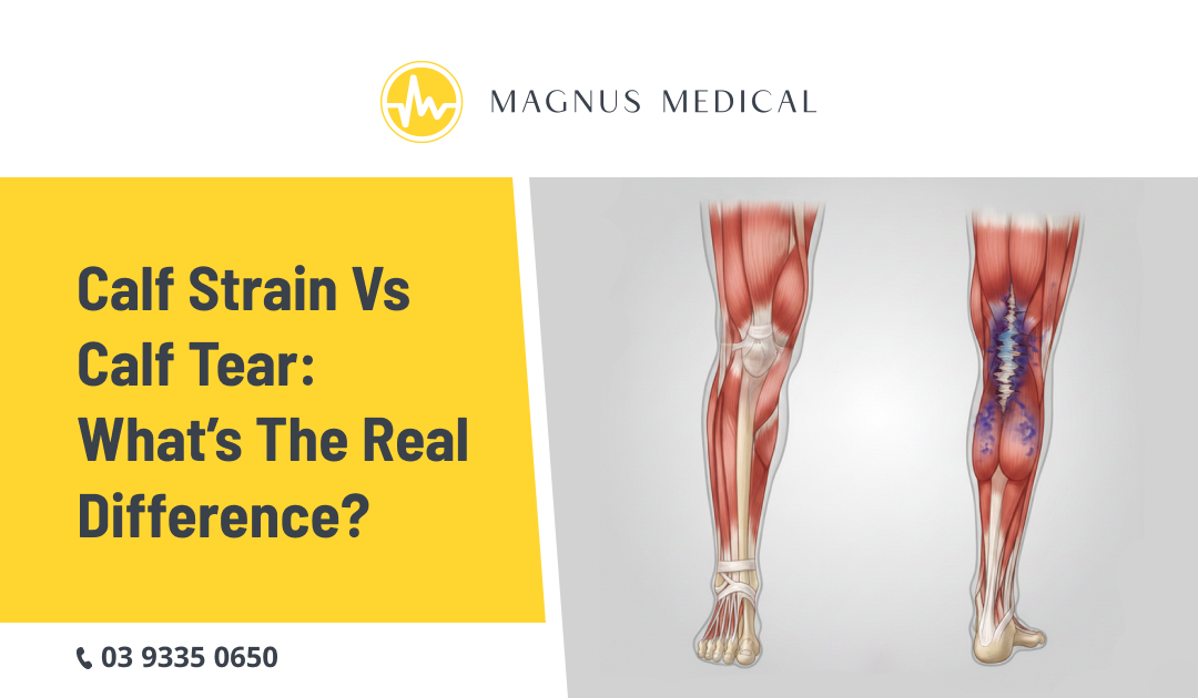 Calf Strain vs Calf Tear