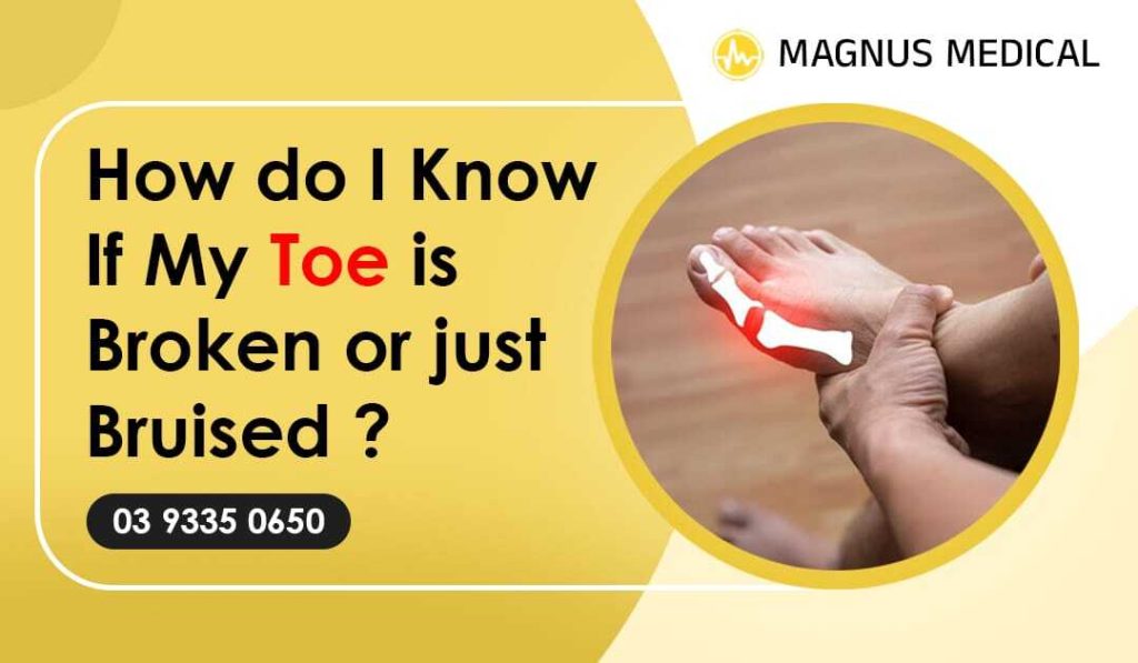 How Do I Know If My Toe Is Broken Or Just Bruised