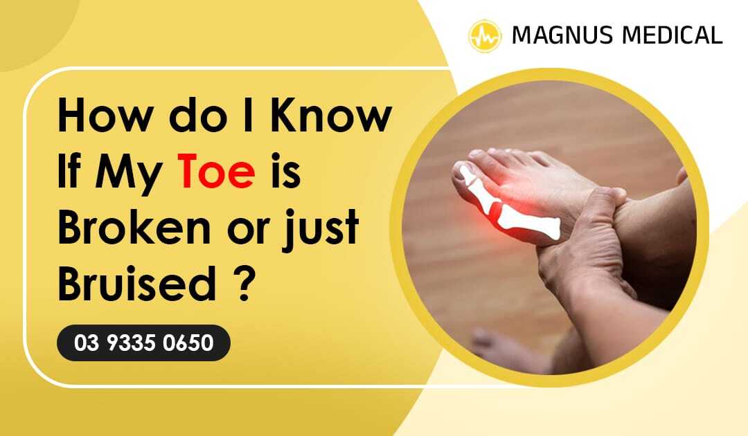 How Do I Know If My Toe Is Broken Or Just Bruised