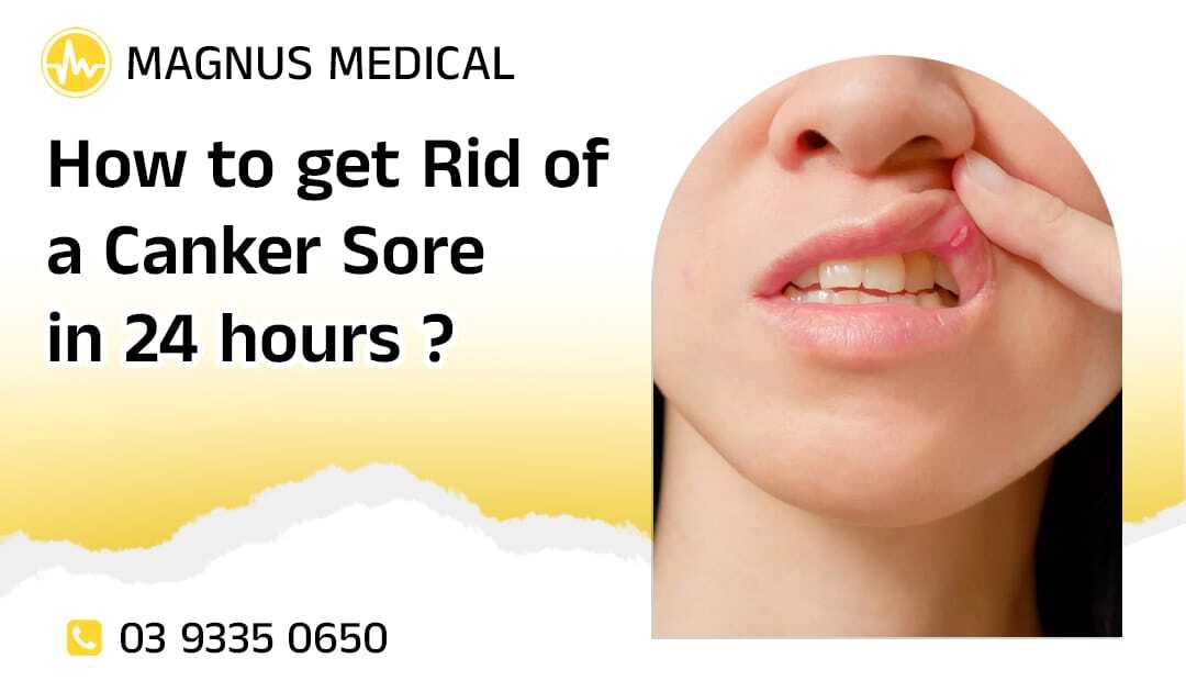 How to Get Rid of a Canker Sore in 24 Hours