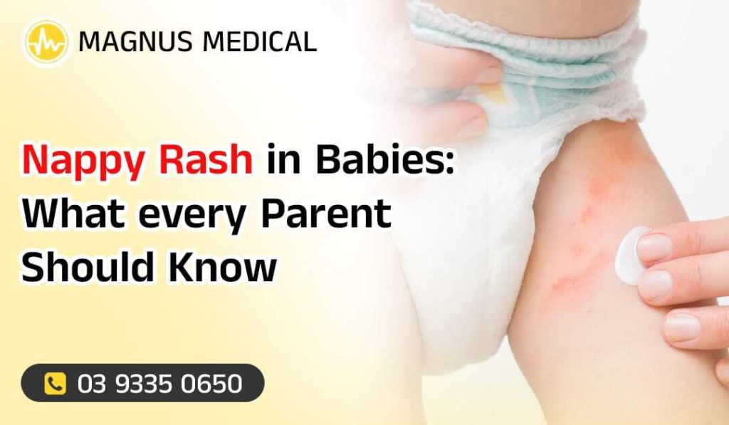 Nappy Rash in Babies