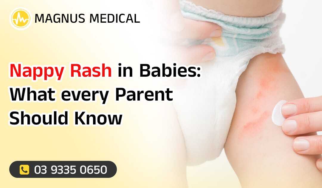 Nappy Rash in Babies