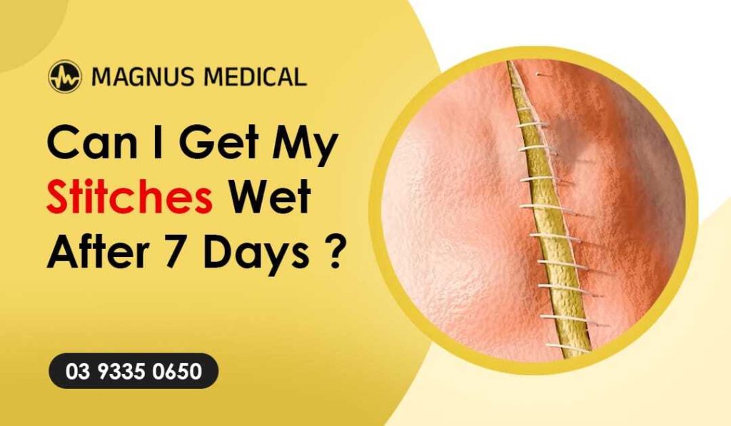 Can I Get My Stitches Wet After 7 Days