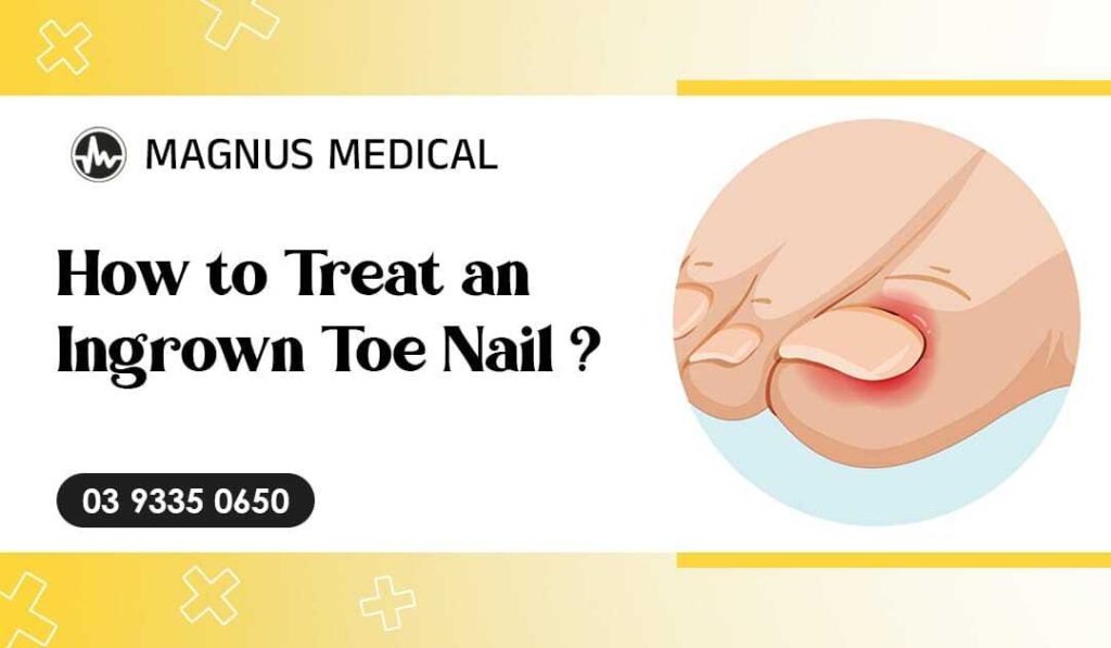 How to Treat an Ingrown Toe Nail