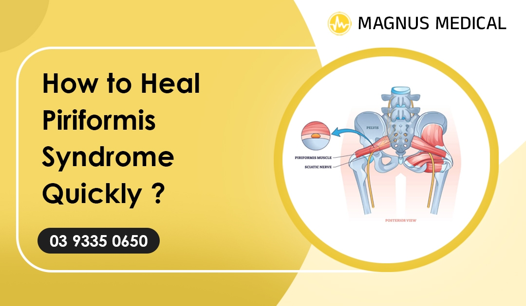 How to Heal Piriformis Syndrome Quickly