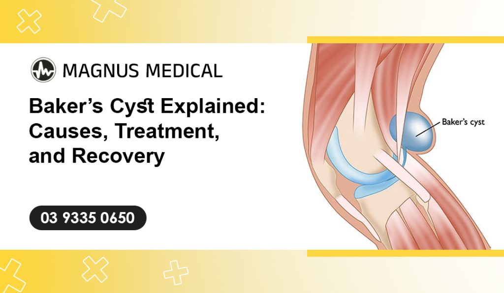 Baker’s Cyst Explained Causes, Treatment, and Recovery